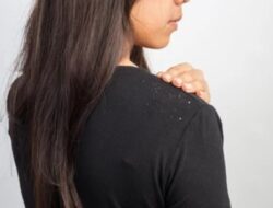 6 Bahan Alami Untuk Mengatasi Ketombe dan Gatal di Kulit Kepala